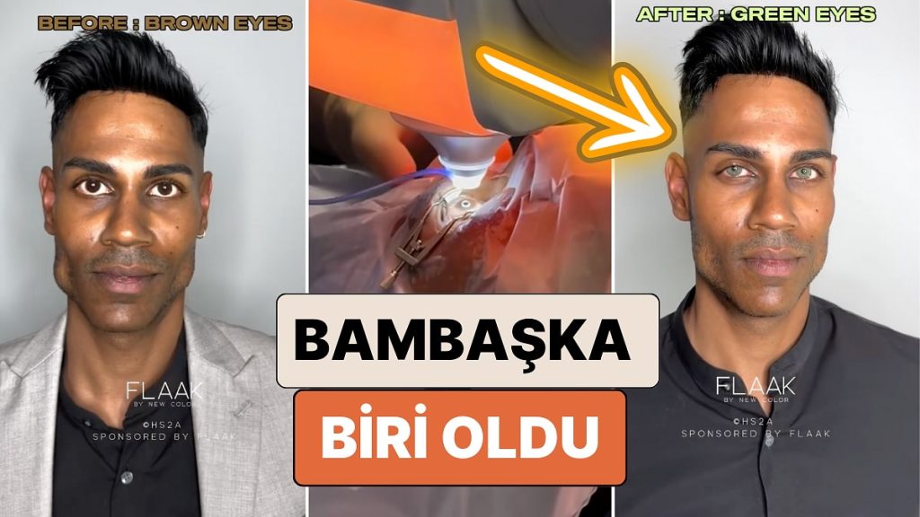 Son Dönemin Popüler Operasyonu Olan “Göz Rengi Değiştirme” İşlemini Yaptıran Genç Bambaşka Biri Oldu