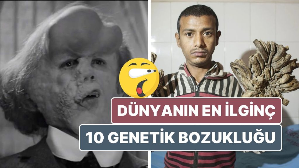Dünyanın En İlginç 10 Genetik Bozukluğu