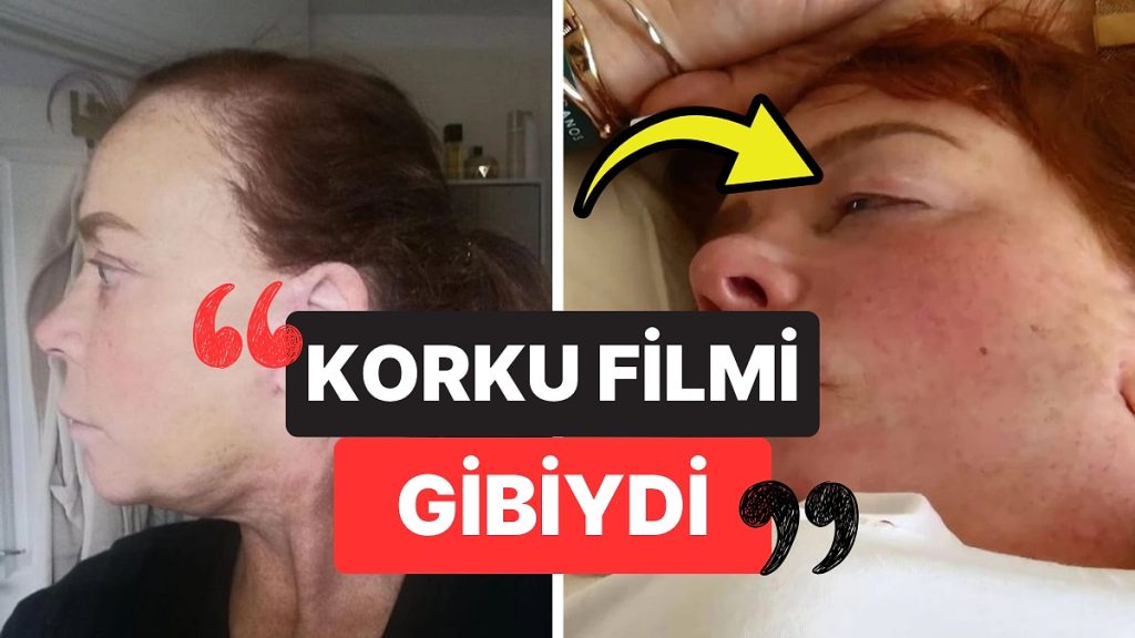 Estetik Operasyon İçin Türkiye’ye Gelen Turist Kadın Göz Kapaklarından Oldu: "Hastane Değil, Kasap"