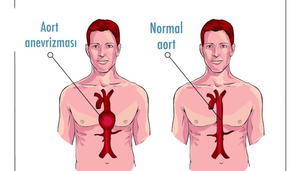 Aort yırtılması nedir, neden olur? Aort yırtılmasının tedavisi var mı?